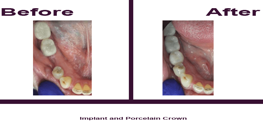 Implant-and-Porcelain-Crown Implant-and-Porcelain-Crown