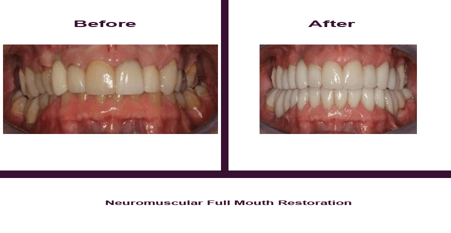 Neuromuscular-Full-Mouth-Restoration-1 Smile Gallery