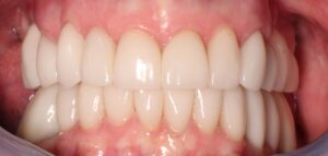 Neuromuscular-Full-Mouth-Restoration-3-After-300x143 Neuromuscular Full Mouth Restoration 3 After