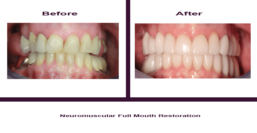 Neuromuscular-Full-Mouth-Restoration-3 Smile Gallery