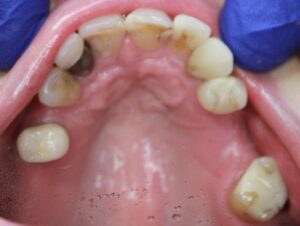 Neuromuscular-Full-Mouth-Restoration-4-Before-300x226 Neuromuscular Full Mouth Restoration 4 Before