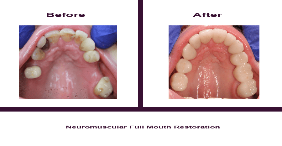 Neuromuscular-Full-Mouth-Restoration-4 Smile Gallery