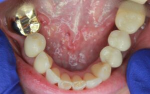 Neuromuscular-Full-Mouth-Restoration-5-Before-300x187 Neuromuscular Full Mouth Restoration 5 Before