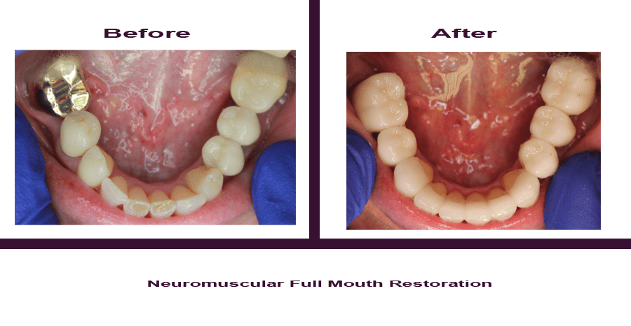 Neuromuscular-Full-Mouth-Restoration-5 Smile Gallery
