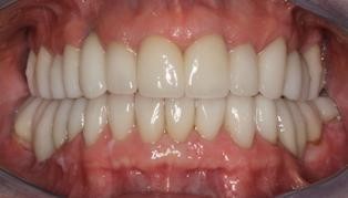 Neuromuscular-Full-Mouth-Restoration-After-1 Neuromuscular Full Mouth Restoration