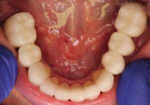 Neuromuscular-Full-Mouth-Restoration-After-2-300x210 Neuromuscular Full Mouth Restoration After