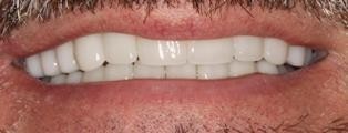 Neuromuscular-Full-Mouth-Restoration-After Neuromuscular Full Mouth Restoration After