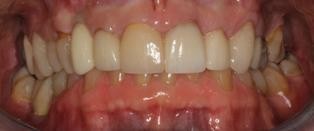 Neuromuscular-Full-Mouth-Restoration-Before-1 Neuromuscular Full Mouth Restoration