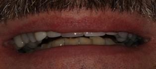 Neuromuscular-Full-Mouth-Restoration-Before Neuromuscular Full Mouth Restoration Before