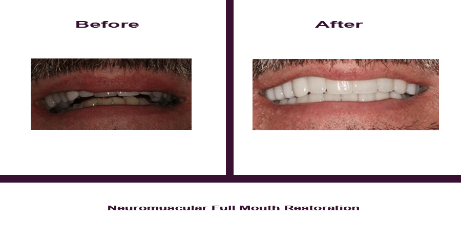 Neuromuscular-Full-Mouth-Restoration Smile Gallery