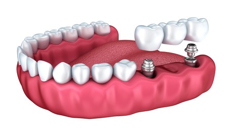 bridges - Grande Prairie Dentist - Boisson Dental Group bridges