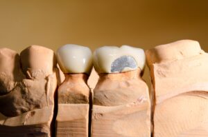 cracked-teeth-300x199 Endodontics