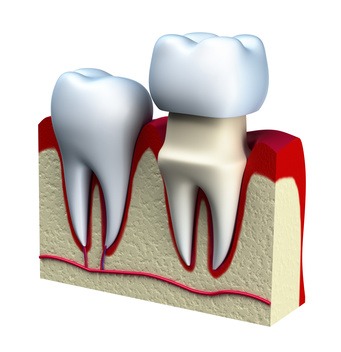 Dental crown 