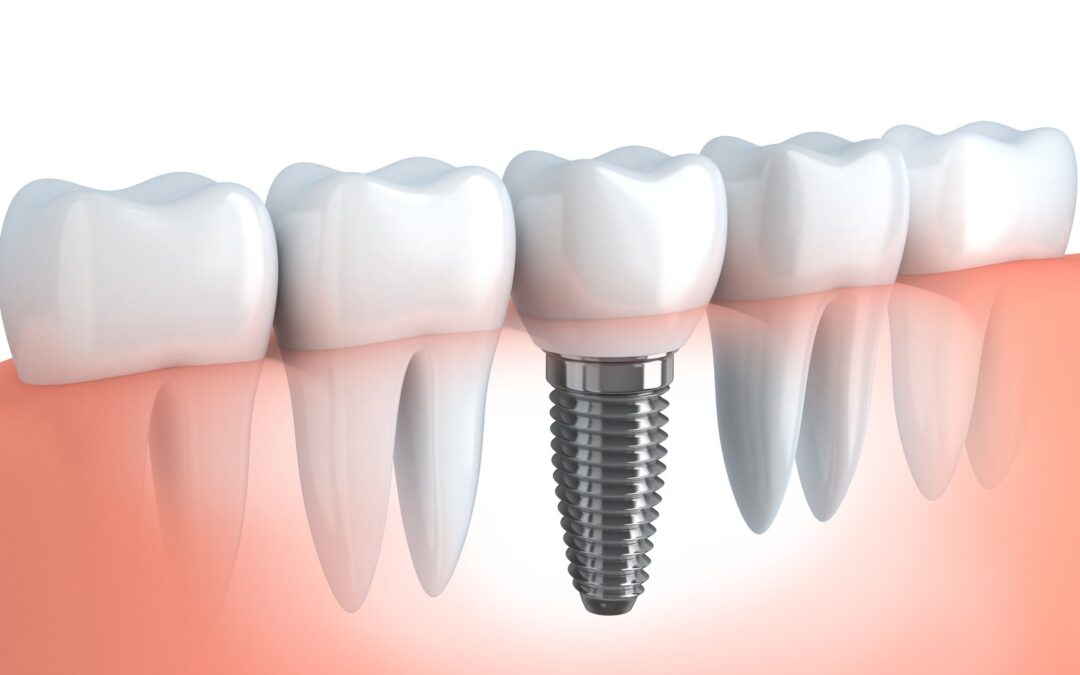 Dealing with missing teeth: What you need to know about dental implant