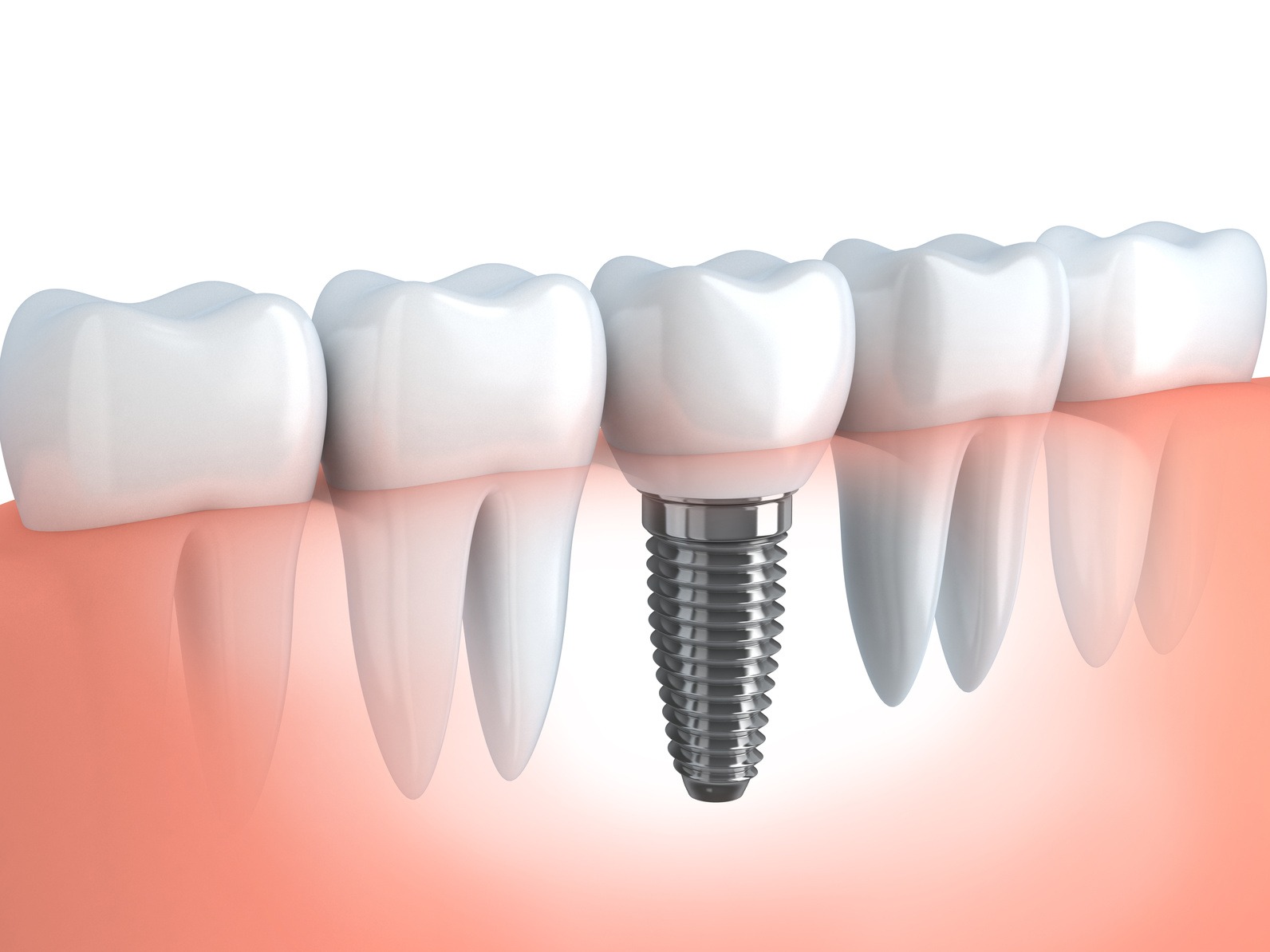 Dealing with missing teeth: What you need to know about dental implant
