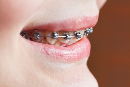 orthodontics dental braces