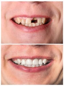 porcelain-fixed-bridges-225x300 Cosmetic Dentistry