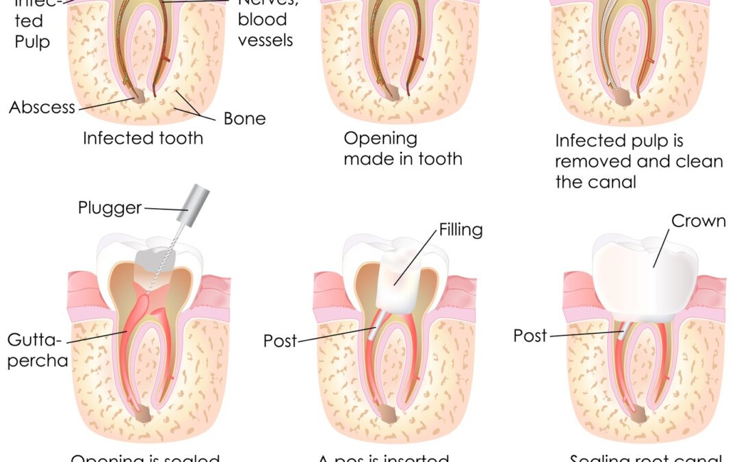 Root Canals: separating fact from myth | Restorative dentistry in Grande Prairie, AB