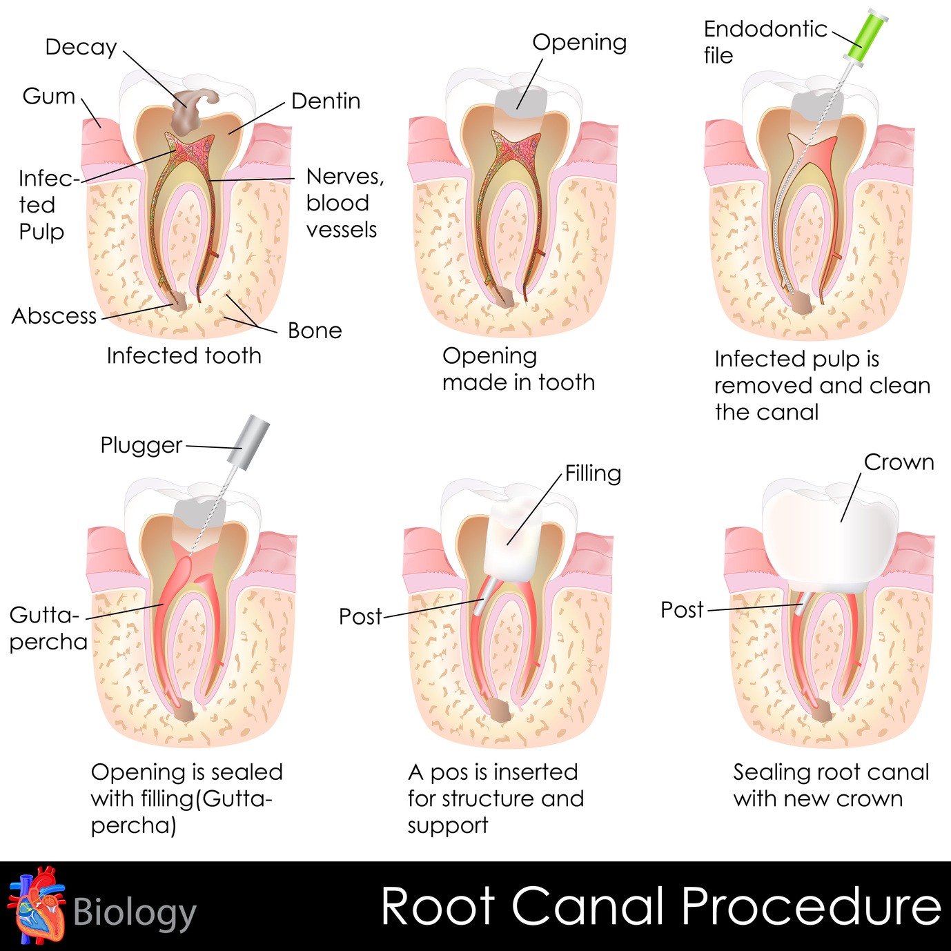 Root Canals: separating fact from myth | Restorative dentistry in Grande Prairie, AB