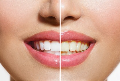 Teeth Before and After Whitening. Oral Care