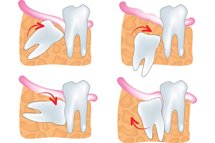 Is it wise to keep your wisdom teeth?