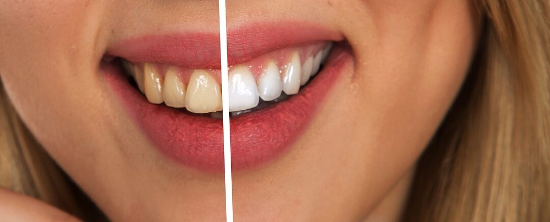 Teeth whitening by Dr. Michael Boisson at Boisson Dental Group in Grande Prairie, Alberta