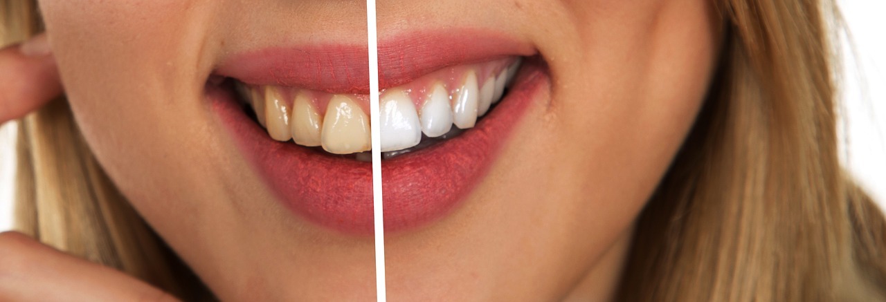 Teeth whitening by Dr. Michael Boisson at Boisson Dental Group in Grande Prairie, Alberta