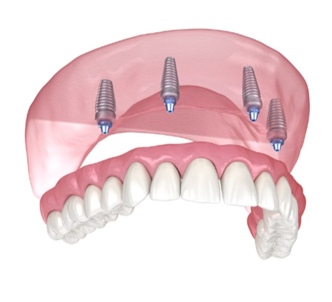 implant-retained dentures - Grande Prairie Dentist - Boisson Dental Group
