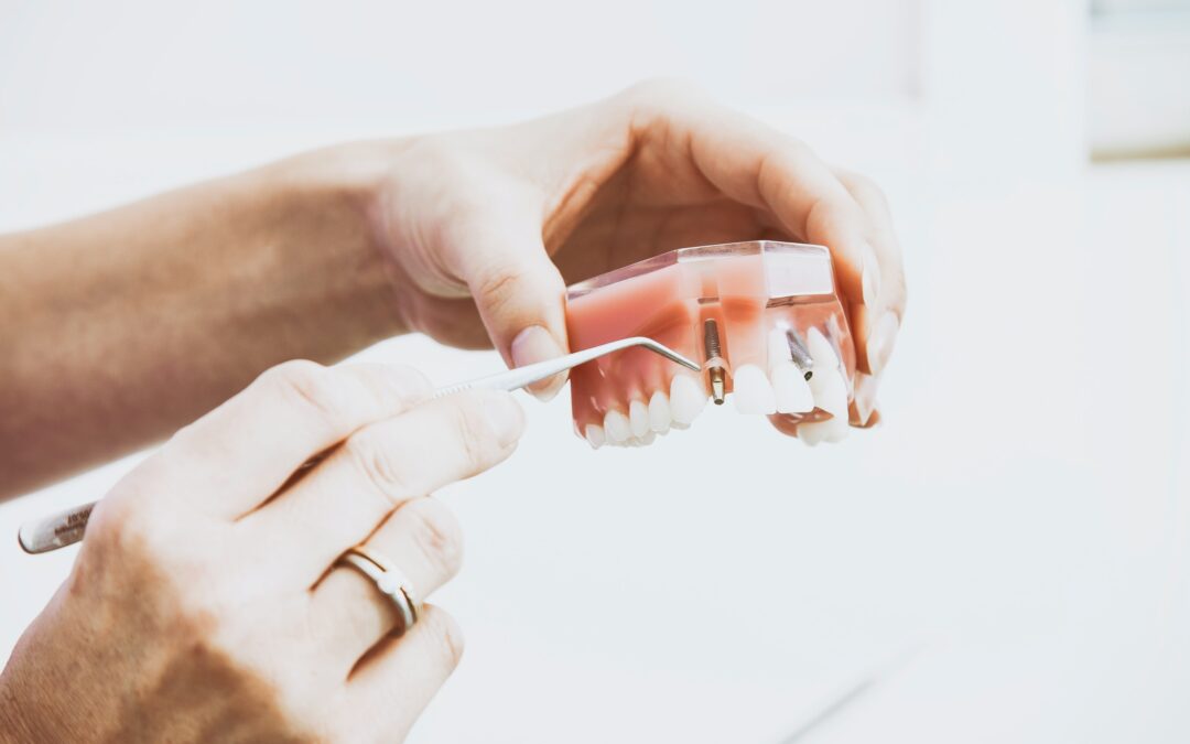 What Are Implant-Retained Dentures?